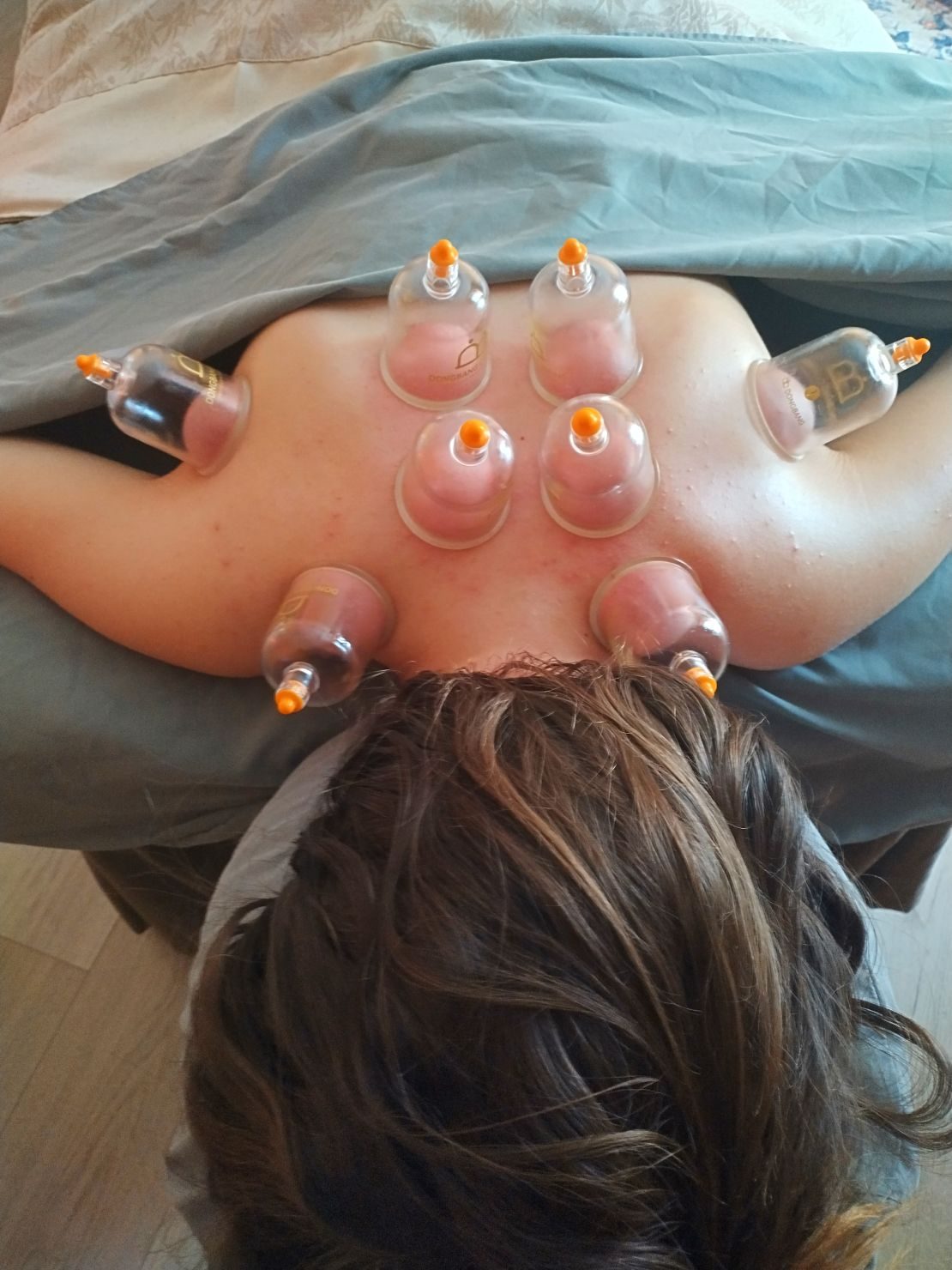 Cupping therapy on a client's upper back
